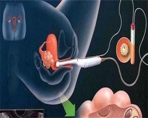 子宫肌瘤哪里试管成功率高？子宫肌瘤哪里试管成功率高一点？~供卵代生全包